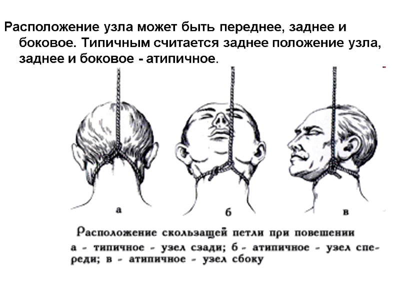 Расположение узла может быть переднее, заднее и боковое. Типичным считается заднее положение узла, заднее